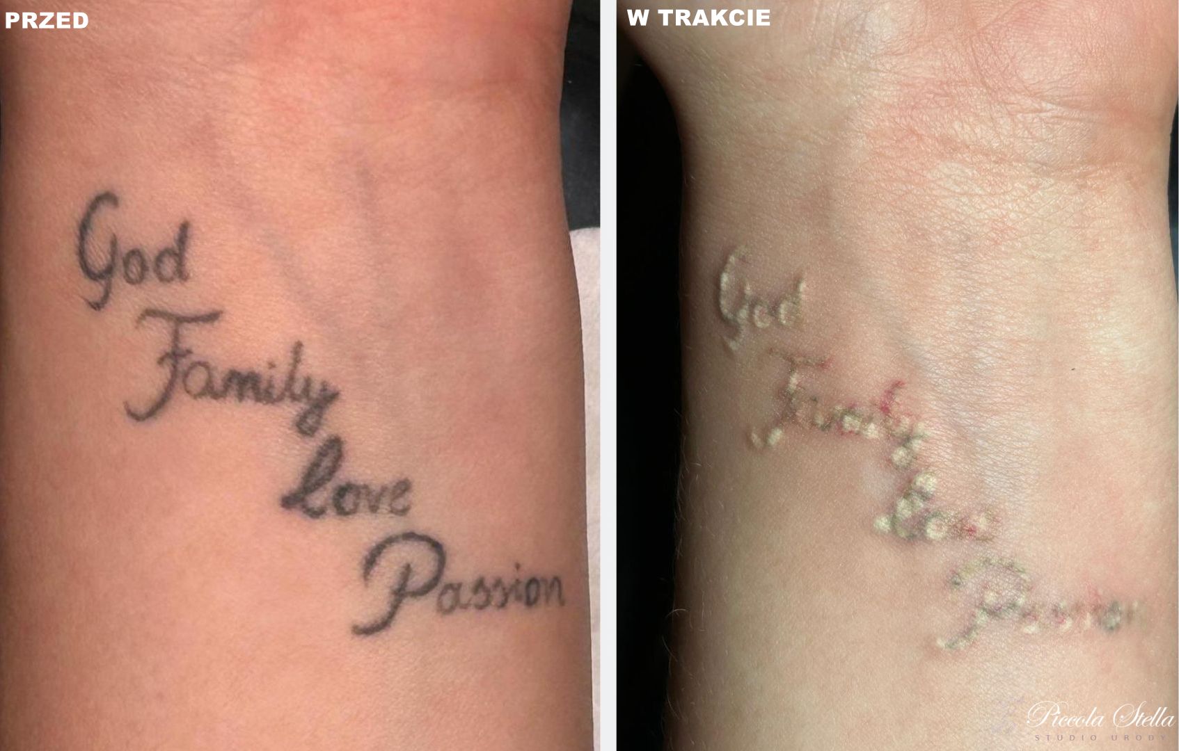 laseroterapia tatuażu